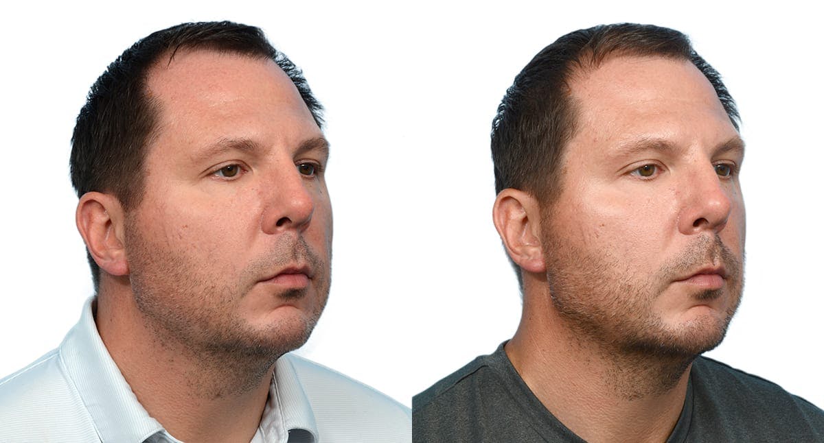 Chin Augmentation Before & After Gallery - Patient 410048 - Image 4