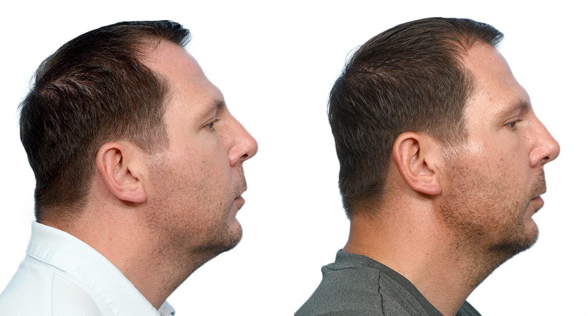 Chin Augmentation Before & After Gallery - Patient 281452 - Image 5
