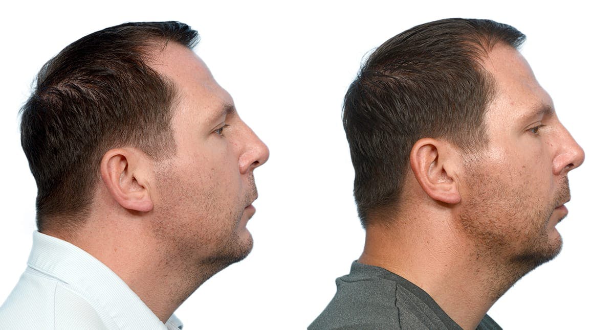 Chin Augmentation Before & After Gallery - Patient 410048 - Image 5