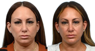 Chin Augmentation Before & After Gallery - Patient 907511 - Image 1