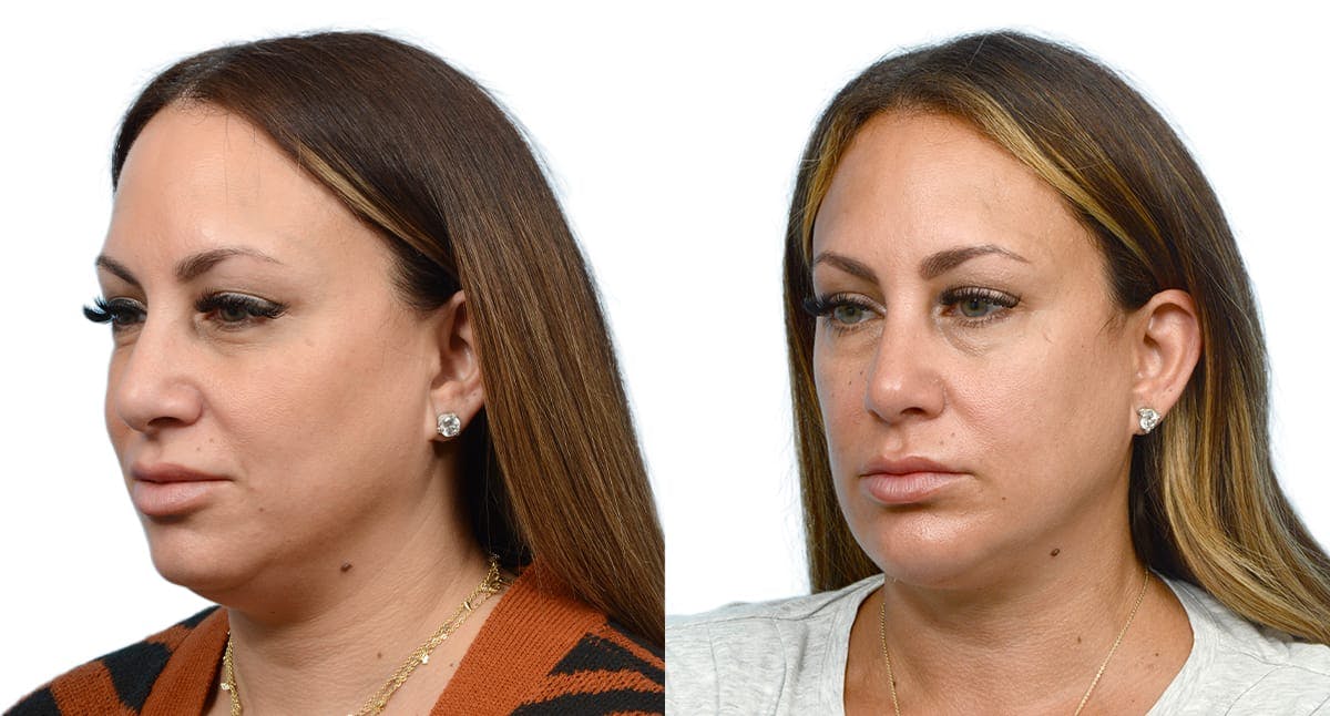 Chin Augmentation Before & After Gallery - Patient 907511 - Image 2