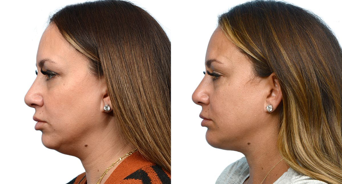 Chin Augmentation Before & After Gallery - Patient 907511 - Image 3