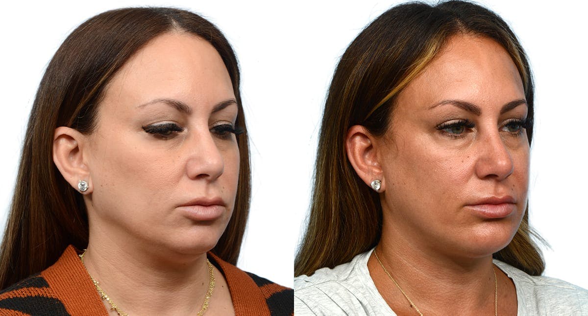 Chin Augmentation Before & After Gallery - Patient 907511 - Image 4