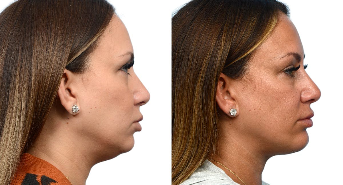Chin Augmentation Before & After Gallery - Patient 907511 - Image 5