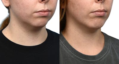 Chin Augmentation Before & After Gallery - Patient 403486 - Image 1