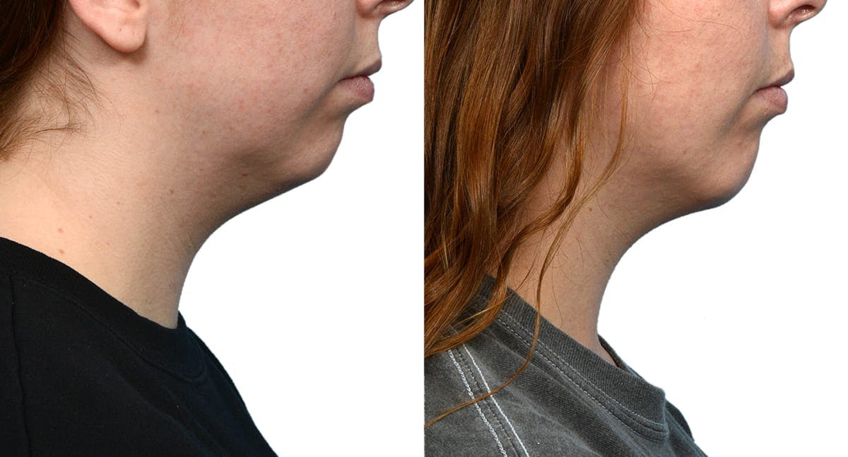 Chin Augmentation Before & After Gallery - Patient 403486 - Image 2