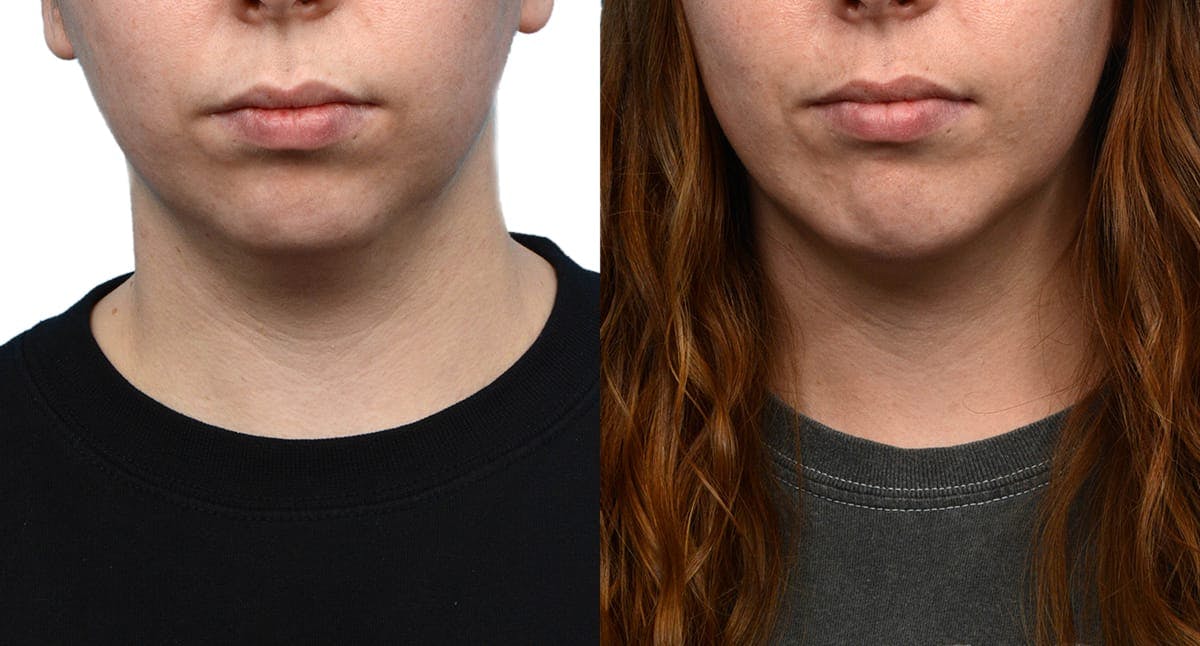 Chin Augmentation Before & After Gallery - Patient 403486 - Image 3