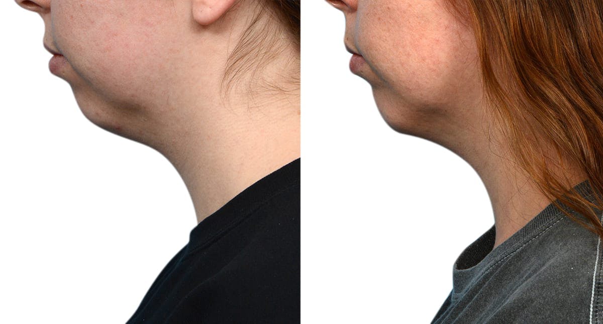 Chin Augmentation Before & After Gallery - Patient 403486 - Image 4