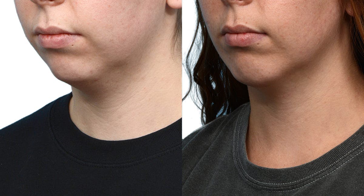 Chin Augmentation Before & After Gallery - Patient 403486 - Image 5
