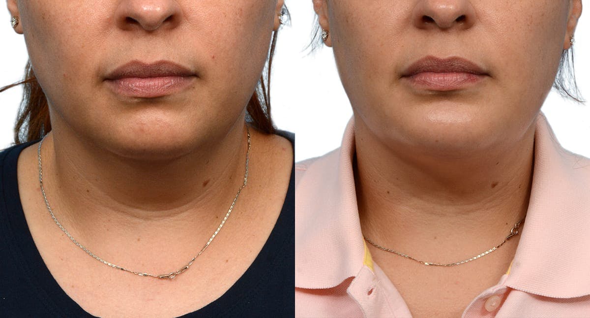 Chin Augmentation Before & After Gallery - Patient 985334 - Image 1