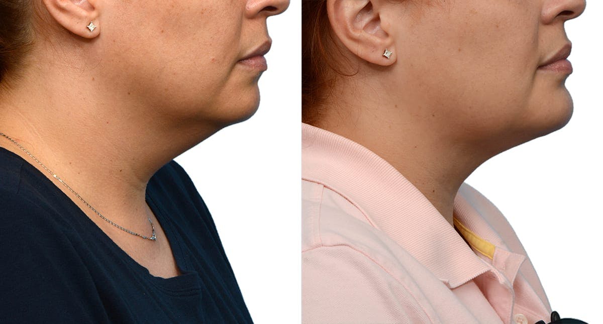 Chin Augmentation Before & After Gallery - Patient 985334 - Image 3