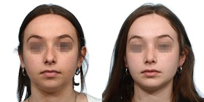 Chin Augmentation Before & After Gallery - Patient 106158 - Image 1