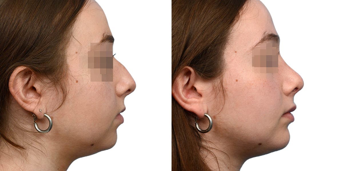 Chin Augmentation Before & After Gallery - Patient 106158 - Image 2