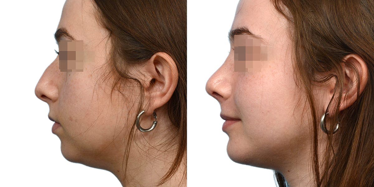 Chin Augmentation Before & After Gallery - Patient 106158 - Image 3