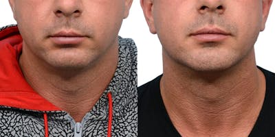 Chin Augmentation Before & After Gallery - Patient 108095 - Image 1