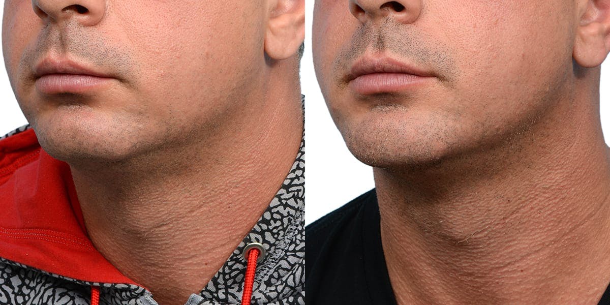 Chin Augmentation Before & After Gallery - Patient 108095 - Image 2