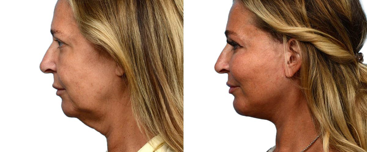Chin Augmentation Before & After Gallery - Patient 195180 - Image 3