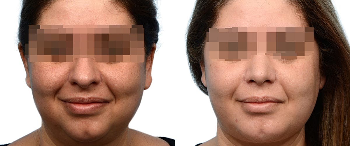 Chin Augmentation Before & After Gallery - Patient 195489 - Image 1