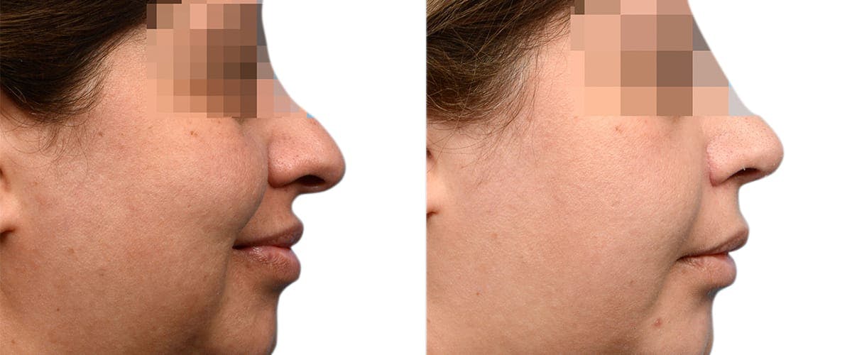 Chin Augmentation Before & After Gallery - Patient 195489 - Image 2