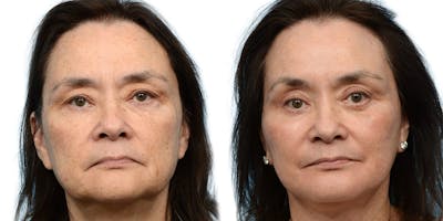 Chin Augmentation Before & After Gallery - Patient 355642 - Image 1