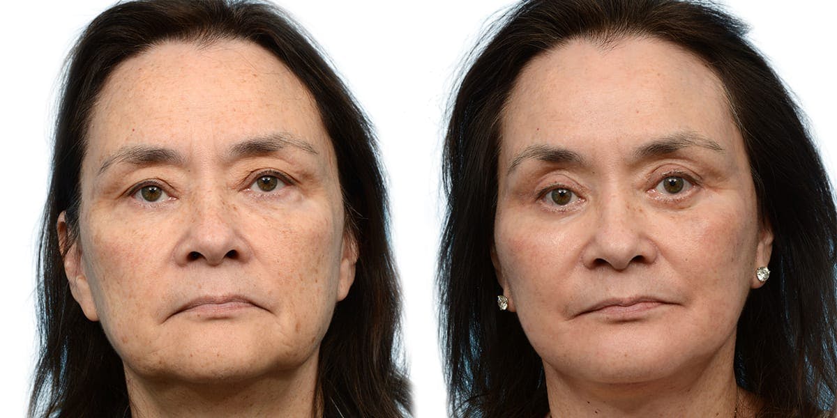 Chin Augmentation Before & After Gallery - Patient 355642 - Image 1