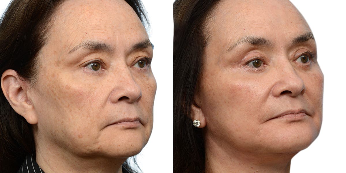 Chin Augmentation Before & After Gallery - Patient 355642 - Image 2