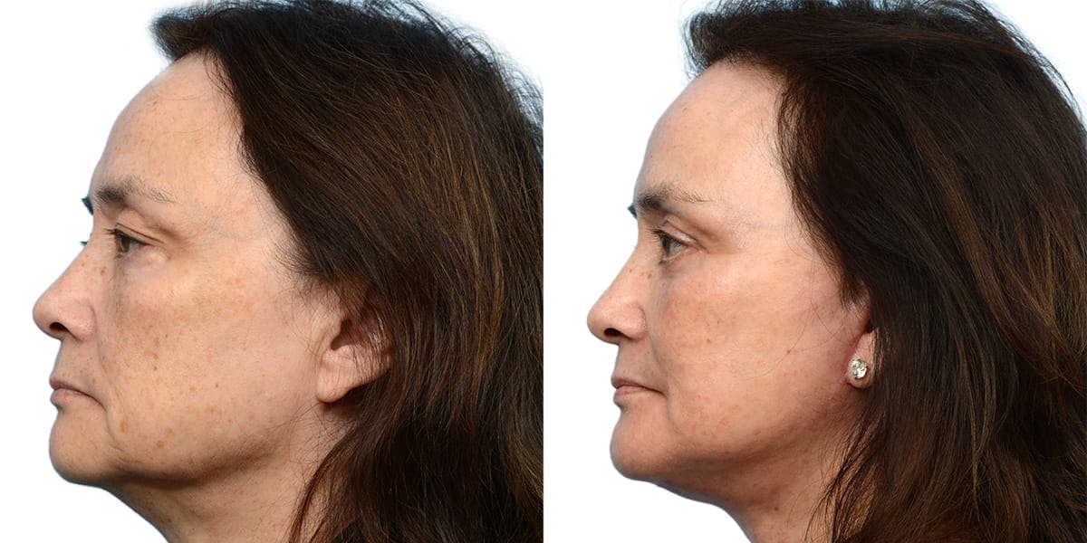 Chin Augmentation Before & After Gallery - Patient 355642 - Image 3