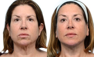 Chin Augmentation Before & After Gallery - Patient 284238 - Image 1