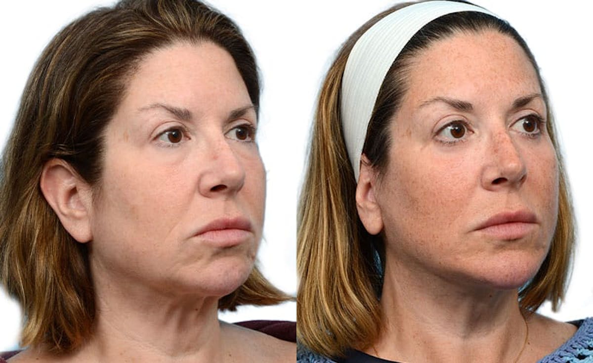 Chin Augmentation Before & After Gallery - Patient 284238 - Image 2