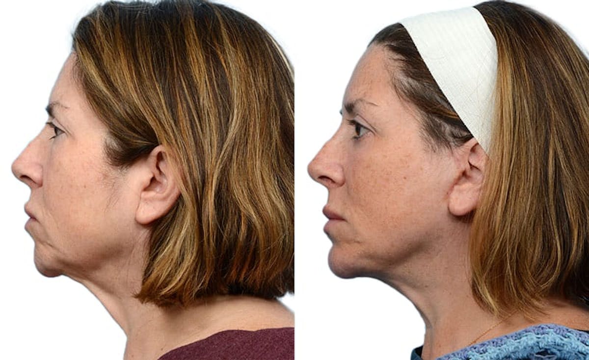 Chin Augmentation Before & After Gallery - Patient 284238 - Image 3