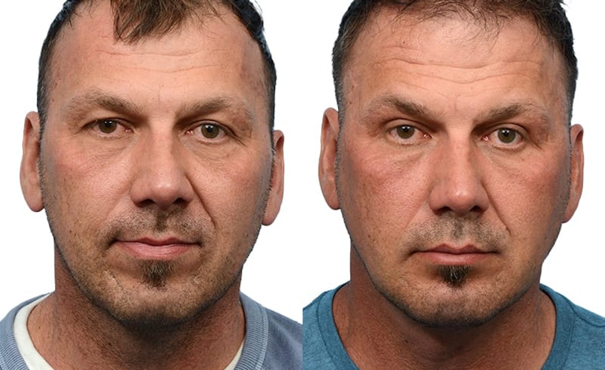 Chin Augmentation Before & After Gallery - Patient 363843 - Image 1