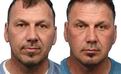 Chin Augmentation Before & After Gallery - Patient 363843 - Image 1