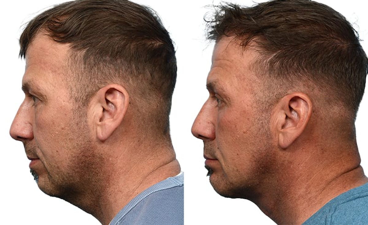 Chin Augmentation Before & After Gallery - Patient 363843 - Image 3
