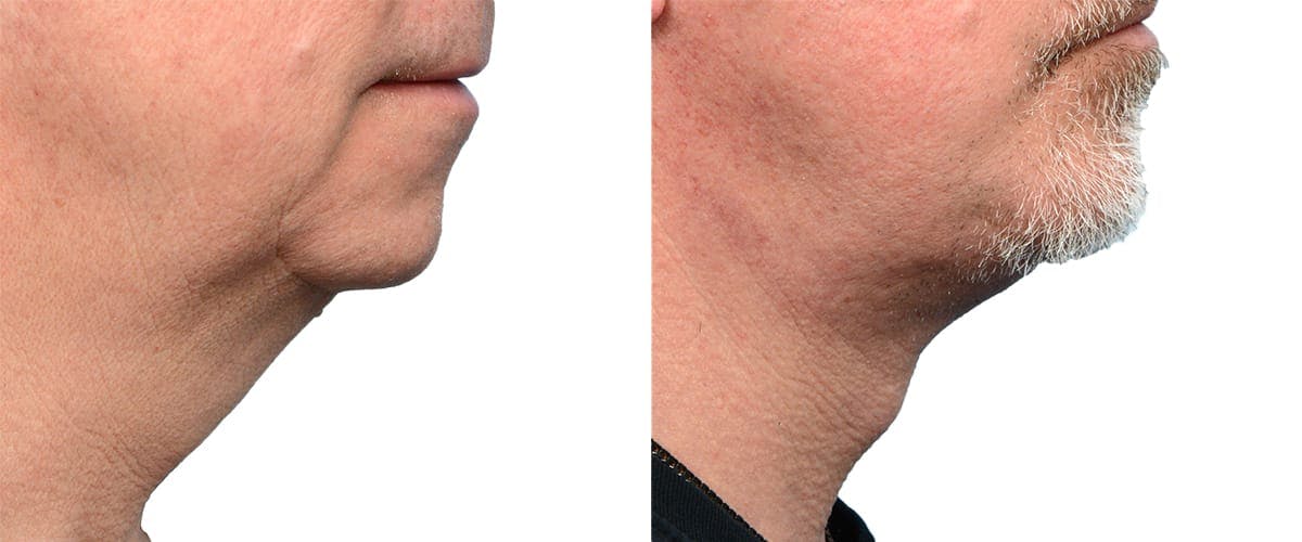 Chin Augmentation Before & After Gallery - Patient 134162 - Image 1