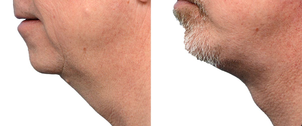 Chin Augmentation Before & After Gallery - Patient 134162 - Image 2