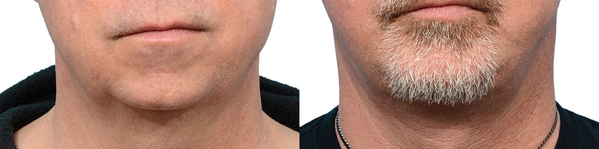 Chin Augmentation Before & After Gallery - Patient 134162 - Image 3