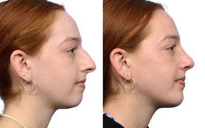 Chin Augmentation Before & After Gallery - Patient 395309 - Image 1