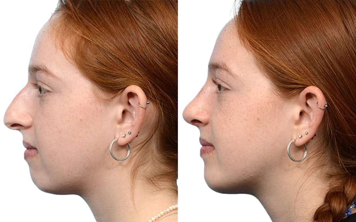 Chin Augmentation Before & After Gallery - Patient 395309 - Image 2