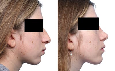 Chin Augmentation Before & After Gallery - Patient 192791 - Image 1