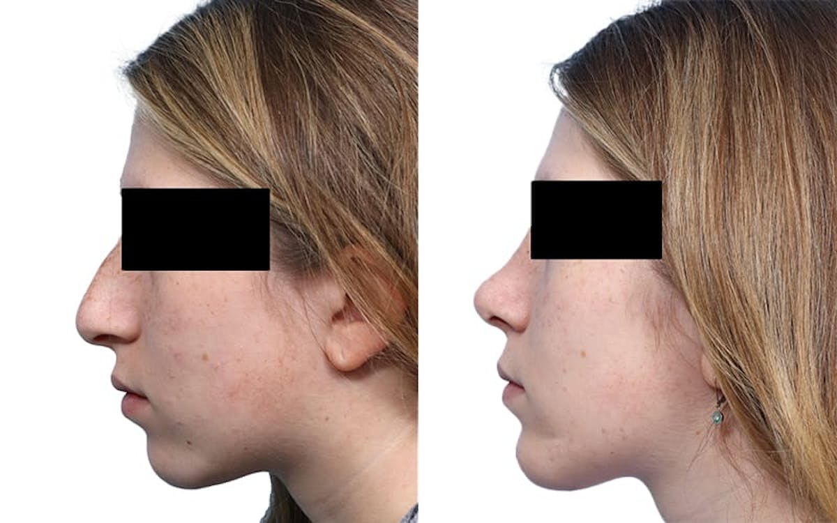 Chin Augmentation Before & After Gallery - Patient 192791 - Image 2