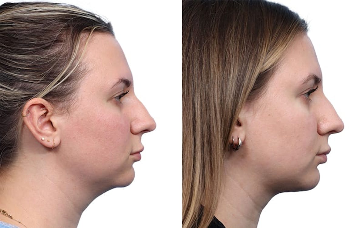 Chin Augmentation Before & After Gallery - Patient 178080 - Image 1