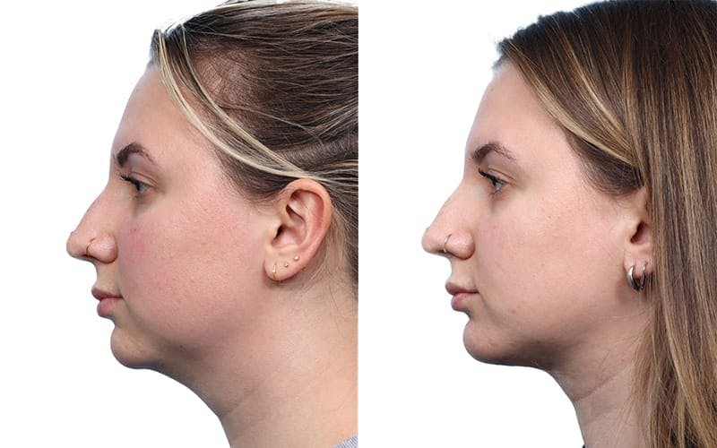 Chin Augmentation Before & After Gallery - Patient 178080 - Image 2
