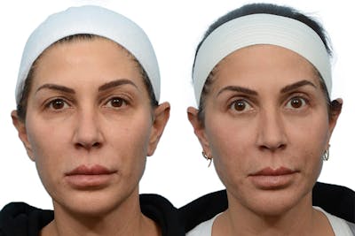 CO2 Laser Before & After Gallery - Patient 252170 - Image 1