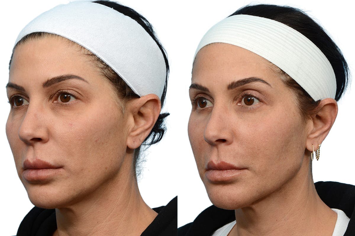 CO2 Laser Before & After Gallery - Patient 252170 - Image 3