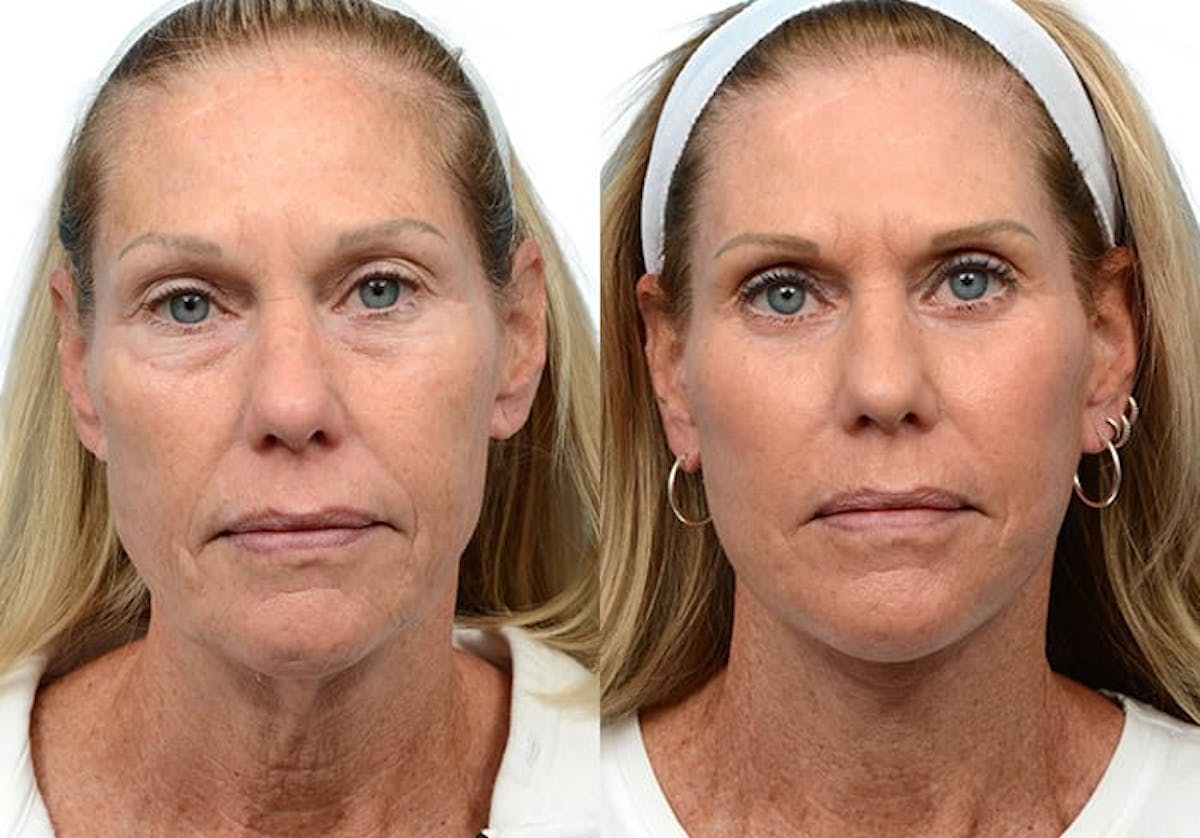 CO2 Laser Before & After Gallery - Patient 209819 - Image 1