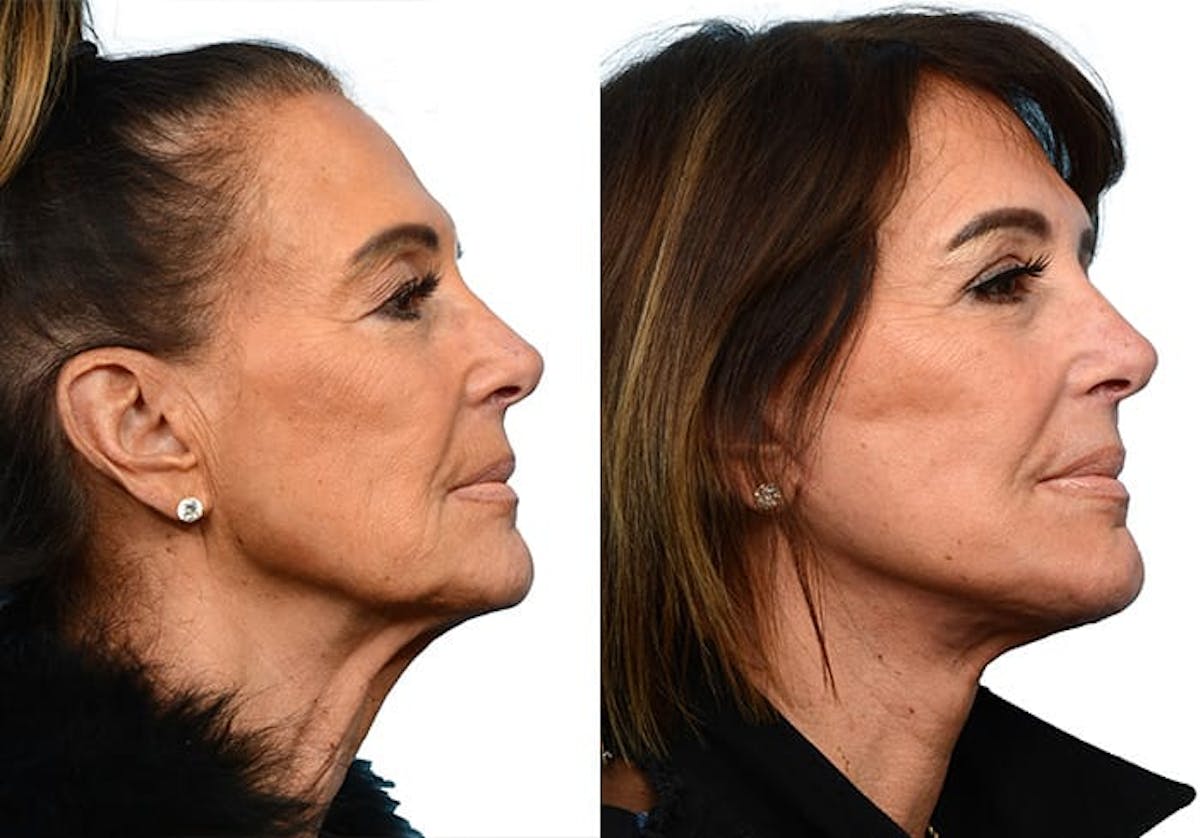 CO2 Laser Before & After Gallery - Patient 120822 - Image 2