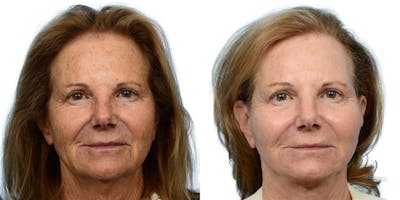 CO2 Laser Before & After Gallery - Patient 117051 - Image 1