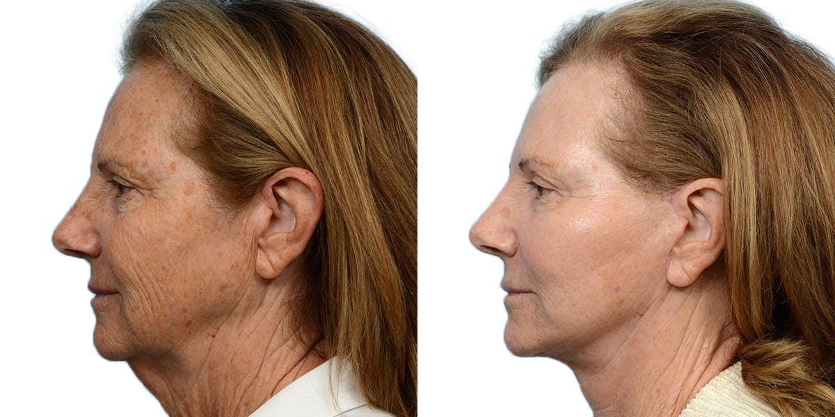 CO2 Laser Before & After Gallery - Patient 117051 - Image 2