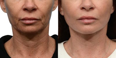 CO2 Laser Before & After Gallery - Patient 258718 - Image 1