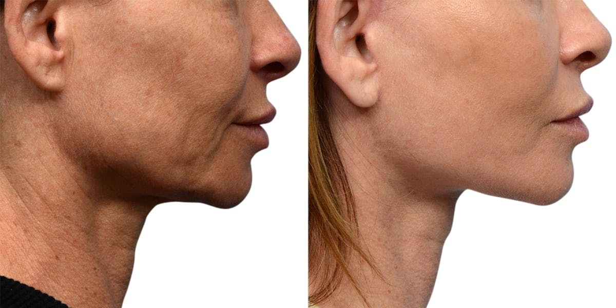 CO2 Laser Before & After Gallery - Patient 258718 - Image 2
